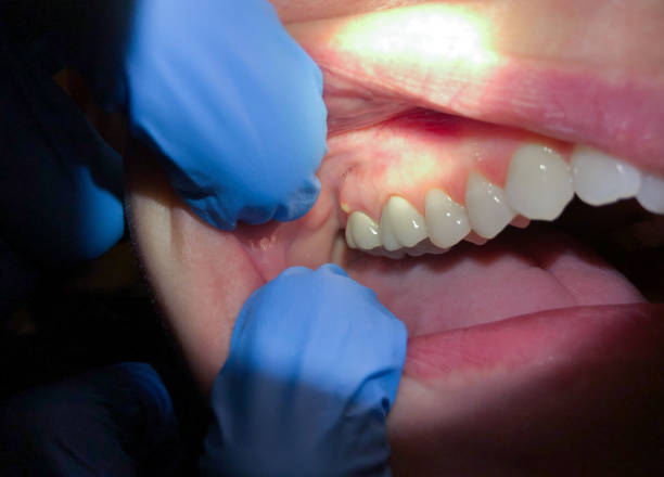 Best Emergency Dentist for Lost Fillings or Crowns in Kalkaska, MI